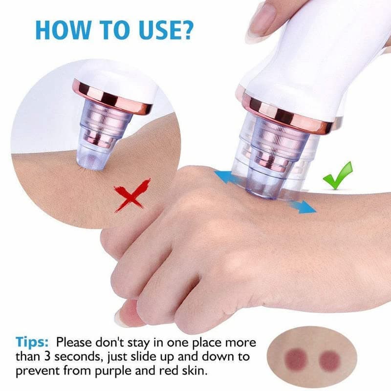 5-in-1 Acne & Blackhead Remover Pro ⭐