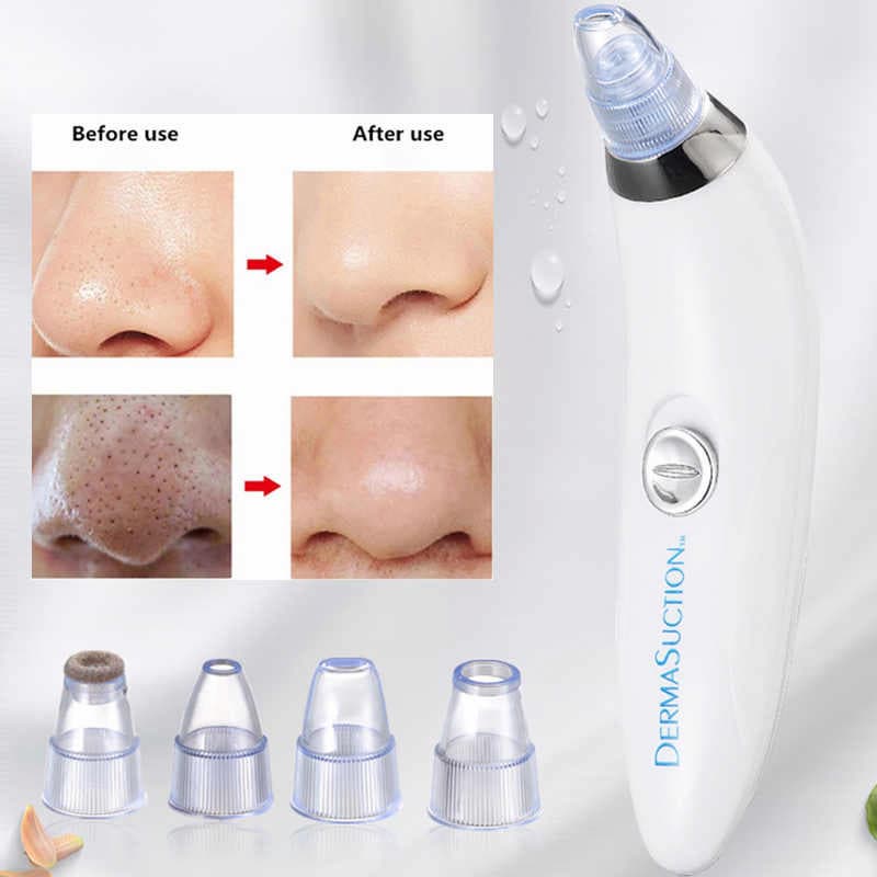 5-in-1 Acne & Blackhead Remover Pro ⭐